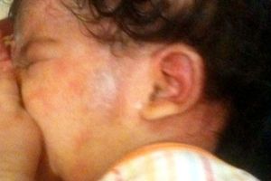 رضيعة تصاب بحروق في الوجهبعد إطلاق غاز مسيل للدموع