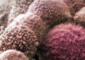 علماء: اختبار منخفض التكاليف لتشخيص سرطان البنكرياس