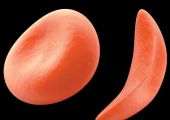 تشخيص فقر الدم المنجلي لدى الجنين