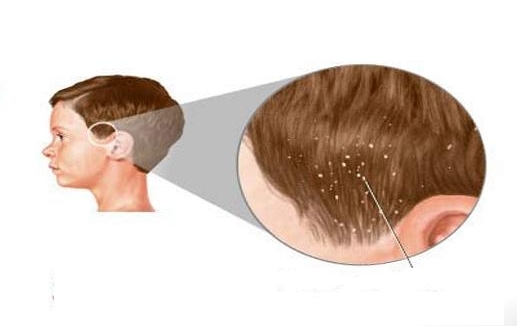 القمل يغزو جسم طفل معاق وحروق بجسمه لتحميمه بماء ساخن والمحكمة تودع والديه الحبس محليات صحيفة الوسط البحرينية مملكة البحرين