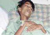 ماليزيا: توأم يستقر في بطن أخيه 15 عاماً