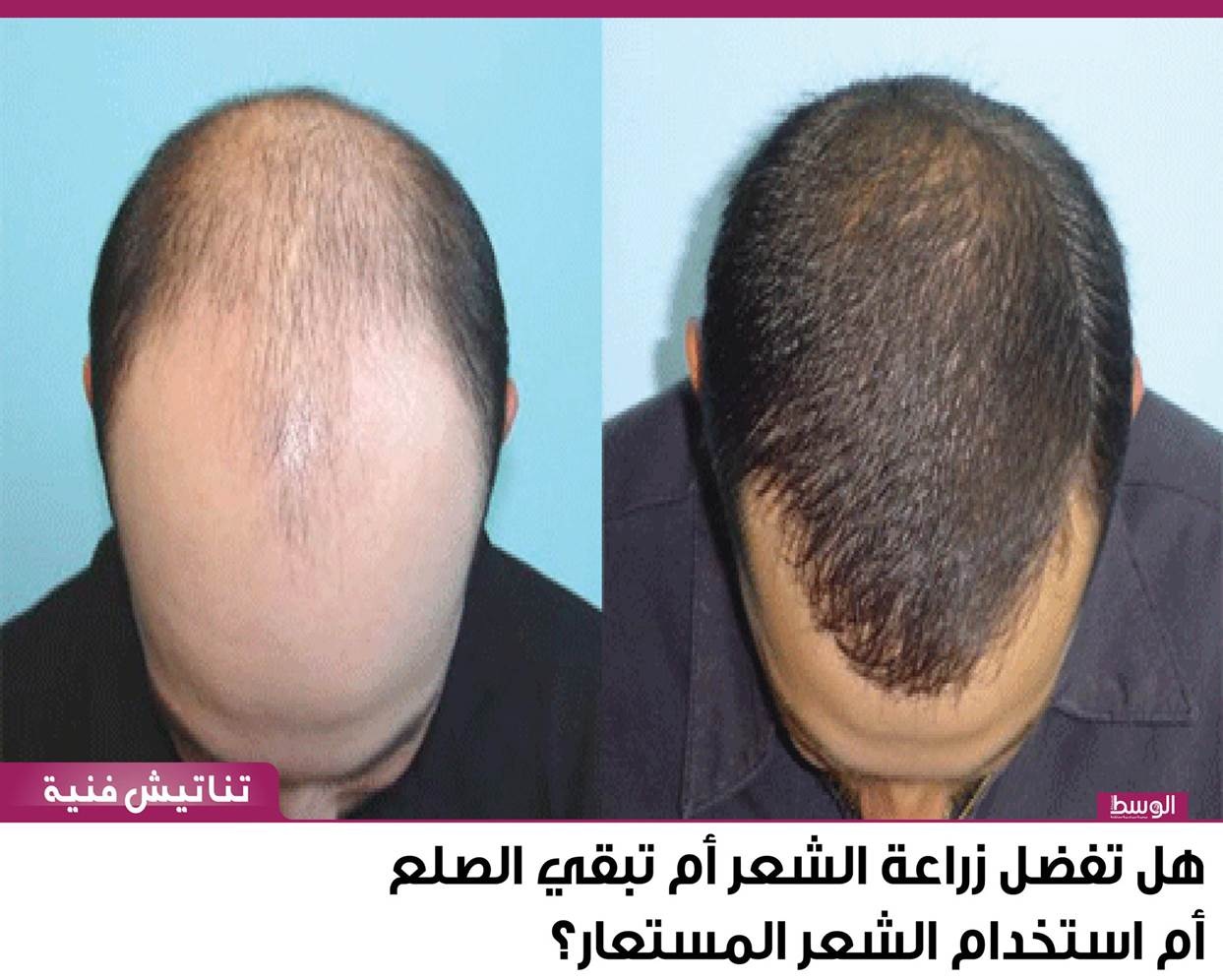 هل تفضل زراعة الشعر أم تبقي الصلع أم استخدام الشعر المستعار منوعات صحيفة الوسط البحرينية مملكة البحرين