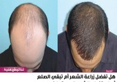 هل تفضل زراعة الشعر أم تبقي الصلع أم استخدام الشعر المستعار؟