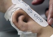 في الصين.. زراعة أذن في ذراع مريض