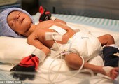 رضيع بـ4 أرجل يجري عملية جراحية ناجحة لإزالة الأطراف الزائدة