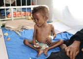 الحملة الوطنية للتحصين تحمي خمسة ملايين طفل من شلل الأطفال في اليمن