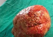 استخراج حجر وزنه 1.36 كلغ من جسم رجل